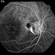 Optic Nerve Pit Optic Nerve Pit